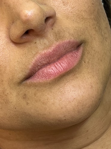 Cláudia antes do preenchimento labial